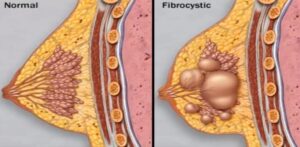 fibrocystic mastopathy, is a non-cancerous condition of the breast characterized by the formation of cysts and fibrotic changes in the breast tissue.