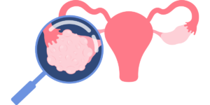 Ovarian cysts: symptoms, how ovarian cysts manifest, what causes ovarian cysts, what can happen when an ovarian cyst bursts, can an ovarian cyst prevent pregnancy, diagnosis and treatment.